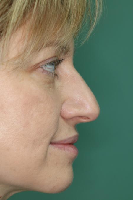 After image 4 Case #120926 - Fat transfer to midface