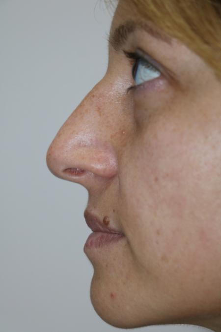 Before image 5 Case #120926 - Fat transfer to midface