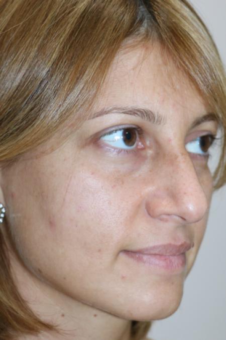 Before image 2 Case #120926 - Fat transfer to midface