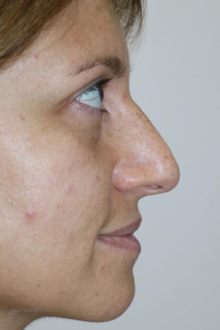 Before image 4 Case #120926 - Fat transfer to midface
