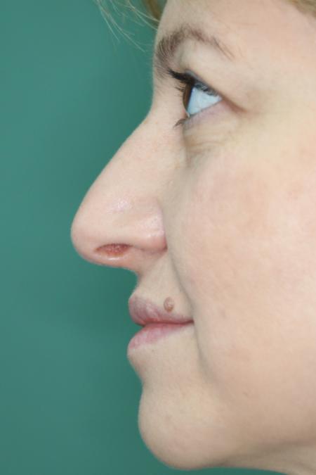 After image 5 Case #120926 - Fat transfer to midface