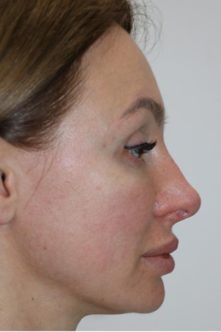 Before Case #122396 - Revision Rhinoplasty 