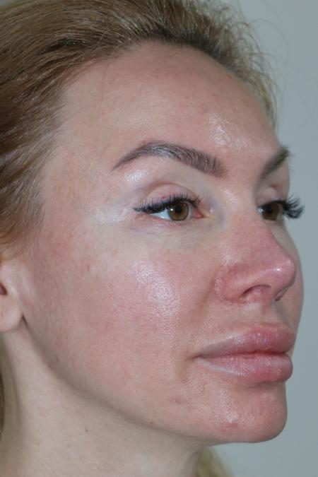 After Case #122396 - Revision Rhinoplasty 