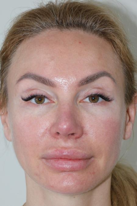 After Case #122396 - Revision Rhinoplasty 
