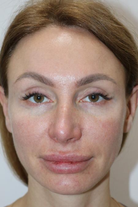 Before Case #122396 - Revision Rhinoplasty 