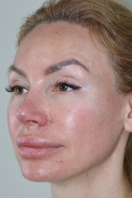 After Case #122396 - Revision Rhinoplasty 