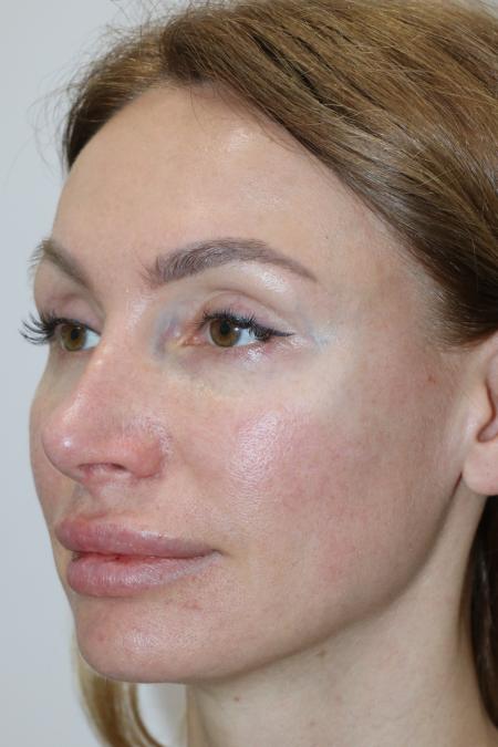 Before Case #122396 - Revision Rhinoplasty 