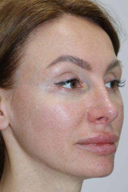 Before Case #122396 - Revision Rhinoplasty 