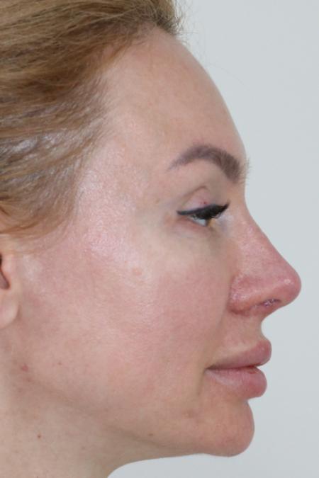 After Case #122396 - Revision Rhinoplasty 