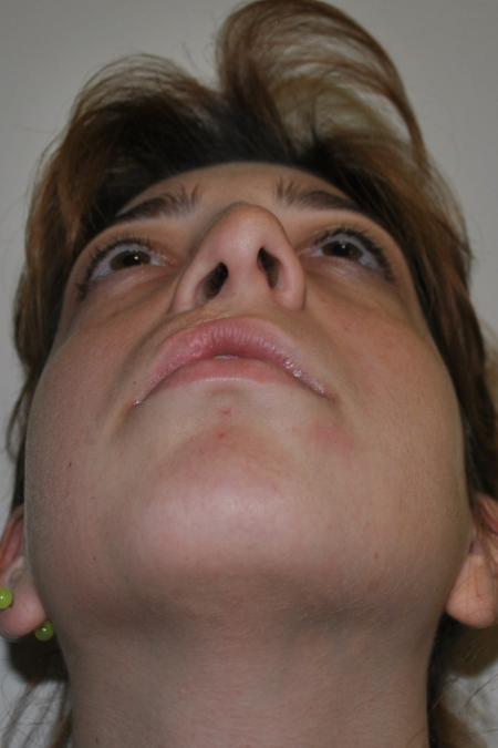 Before image 6 Case #123116 - Late Cleft Lip Nasal Deformity 