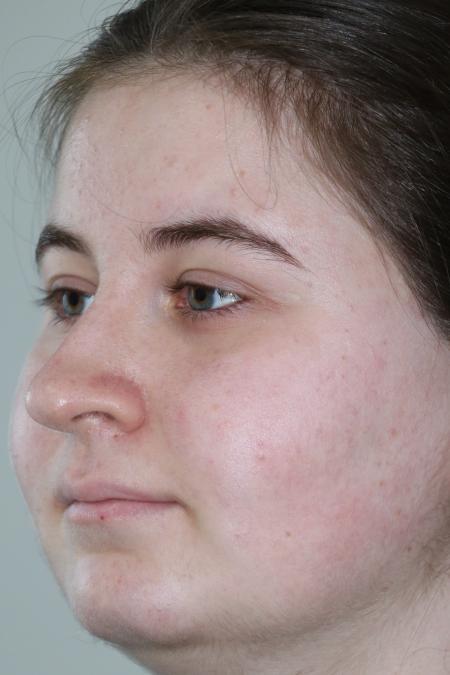 Before image 2 Case #122866 - Nasal Deviation Syndrome