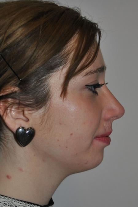 After image 5 Case #122736 - Hybrid Rhinoplasty