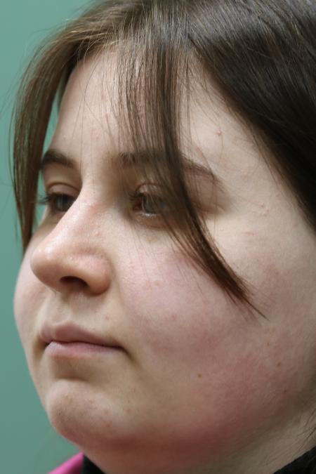 After image 2 Case #122866 - Nasal Deviation Syndrome