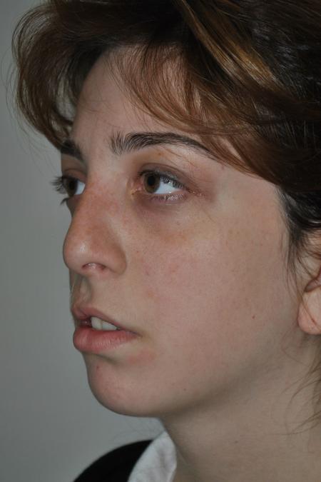 Before image 3 Case #123116 - Late Cleft Lip Nasal Deformity 