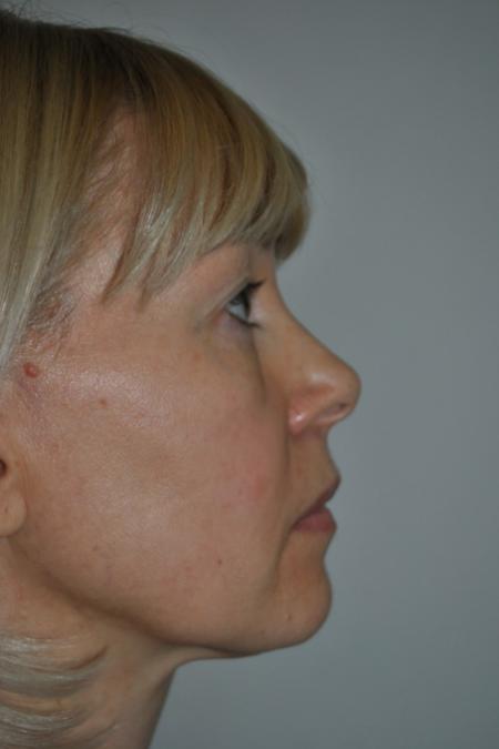 Before image 4 Case #122606 - Fat Transfer