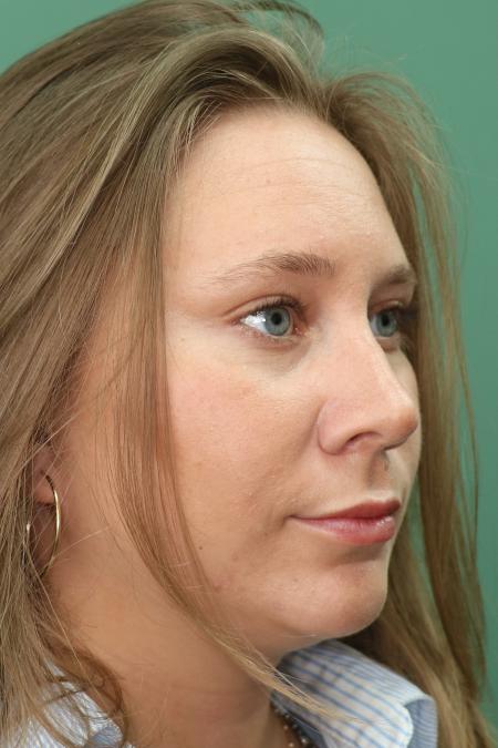 After image 3 Case #122876 - Nasal Deviation Syndrome. Rhinogenic Headache 
