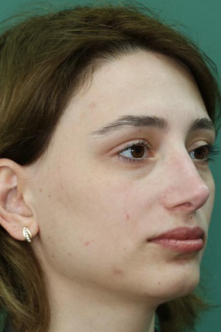 After image 3 Case #122881 - Deviation Syndrome. Rhinogenic Headache 