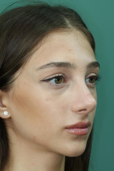 After image 3 Case #122801 - Reduction Rhinoseptoplasty