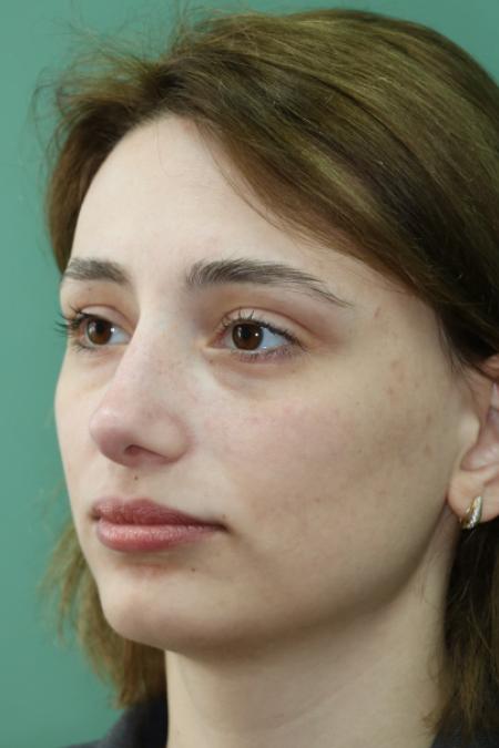 After image 2 Case #122881 - Deviation Syndrome. Rhinogenic Headache 