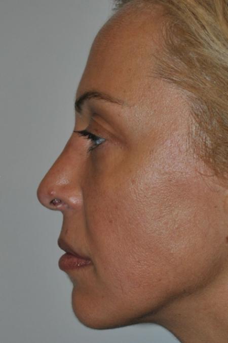 Before image 5 Case #122731 - Revision Rhinoplasty