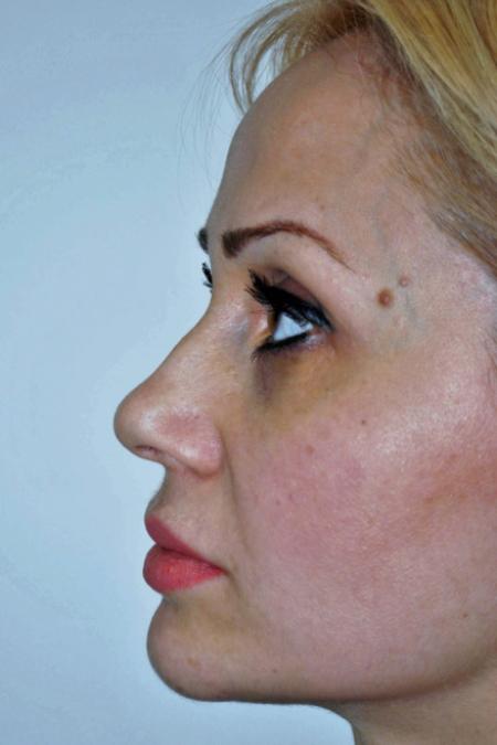 Before image 3 Case #122751 - Aesthetic Reduction Rhinoseptoplasty