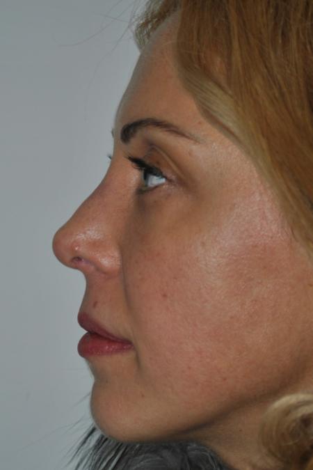 After image 5 Case #122731 - Revision Rhinoplasty