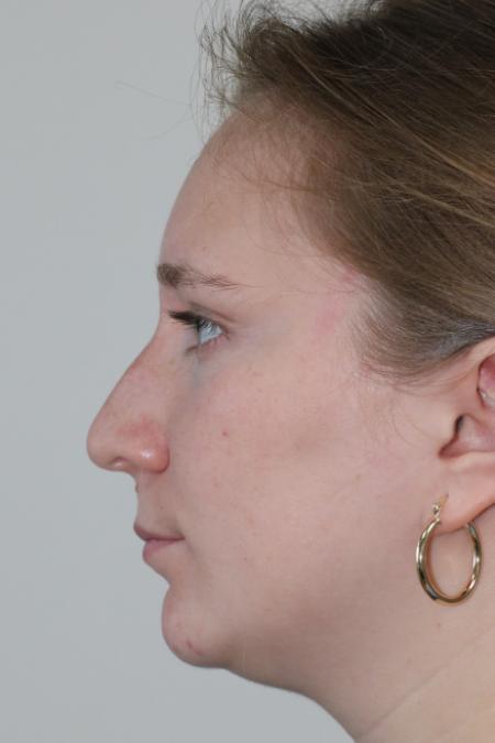 Before image 5 Case #122876 - Nasal Deviation Syndrome. Rhinogenic Headache 