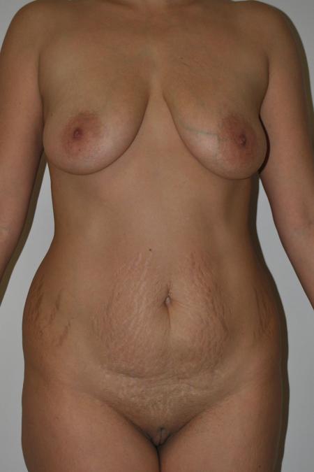 Before image 1 Case #122896 - Breast Autoaugmentation & No Drains Abdominoplasty