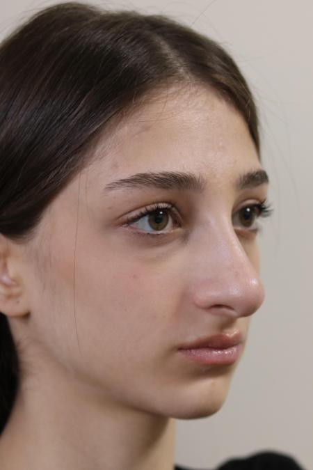 Before image 3 Case #122801 - Reduction Rhinoseptoplasty