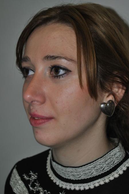 After image 3 Case #122736 - Hybrid Rhinoplasty