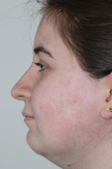 Before image 5 Case #122866 - Nasal Deviation Syndrome