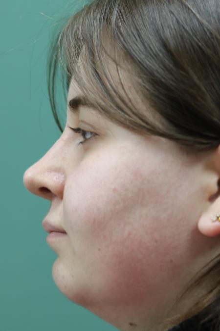 After image 5 Case #122866 - Nasal Deviation Syndrome