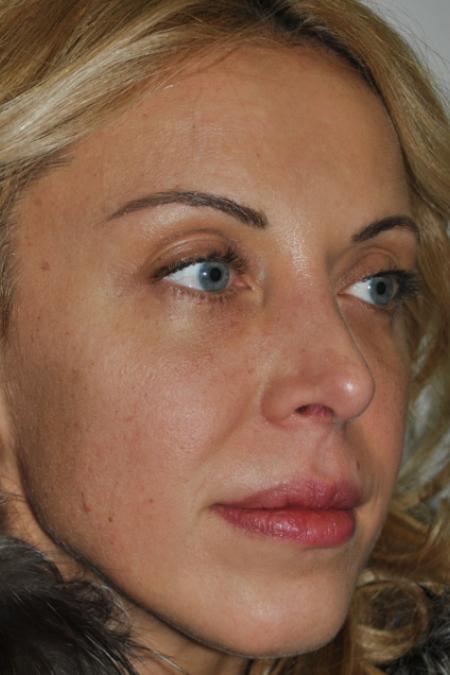 After image 3 Case #122731 - Revision Rhinoplasty