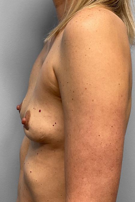 After image 3 Case #123246 - Breast Implant Removal