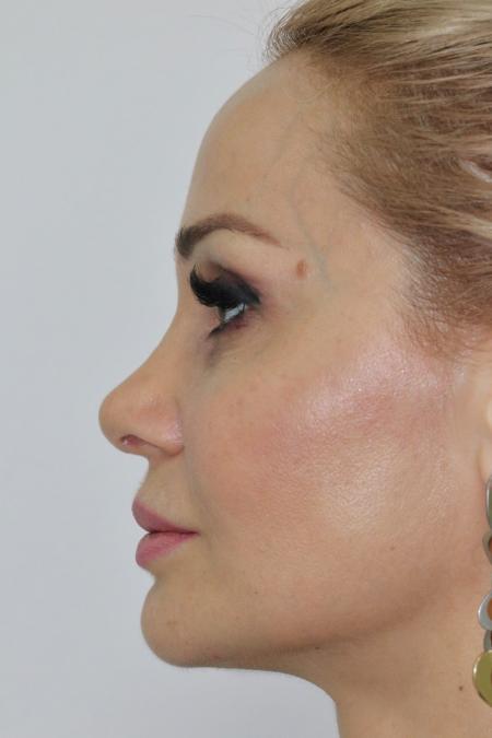 After image 3 Case #122751 - Aesthetic Reduction Rhinoseptoplasty