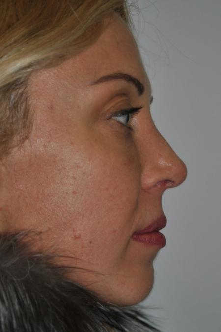 After image 4 Case #122731 - Revision Rhinoplasty