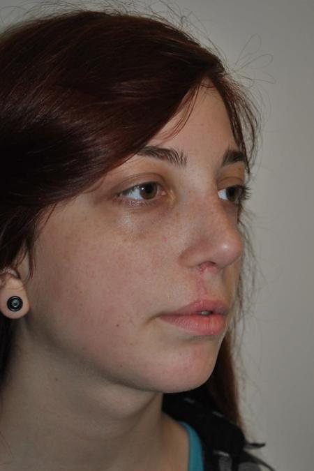 After image 2 Case #122581 - Cleft-Lip Nose Secondary Reconstruction