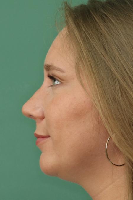 After image 5 Case #122876 - Nasal Deviation Syndrome. Rhinogenic Headache 