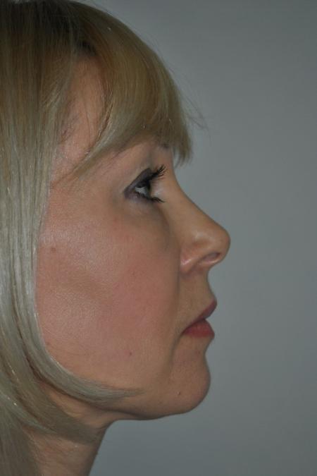 After image 4 Case #122606 - Fat Transfer