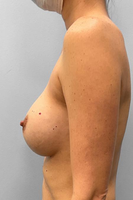 Before image 3 Case #123246 - Breast Implant Removal