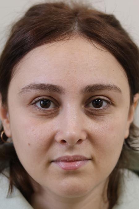 After image 1 Case #122861 - Aesthetic Reduction Rhinoplasty