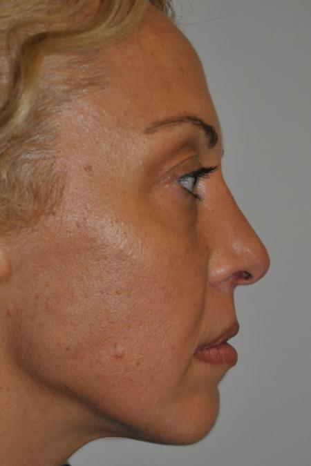 Before image 4 Case #122731 - Revision Rhinoplasty