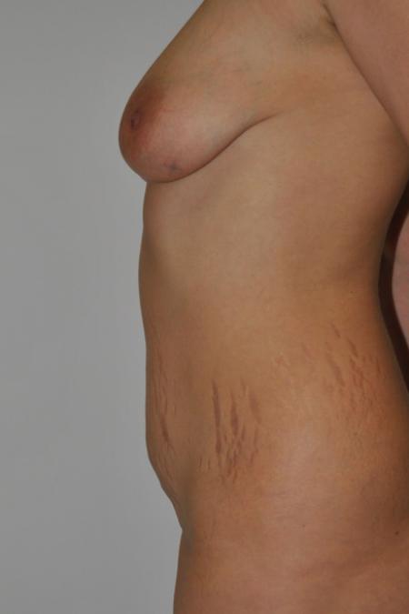 Before image 2 Case #122896 - Breast Autoaugmentation & No Drains Abdominoplasty