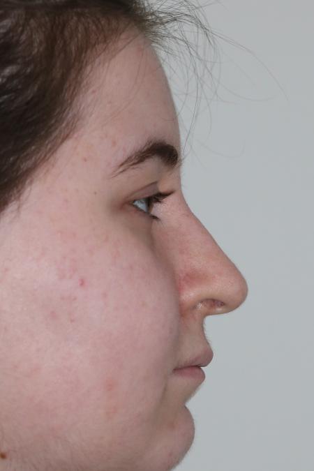 Before image 4 Case #122866 - Nasal Deviation Syndrome