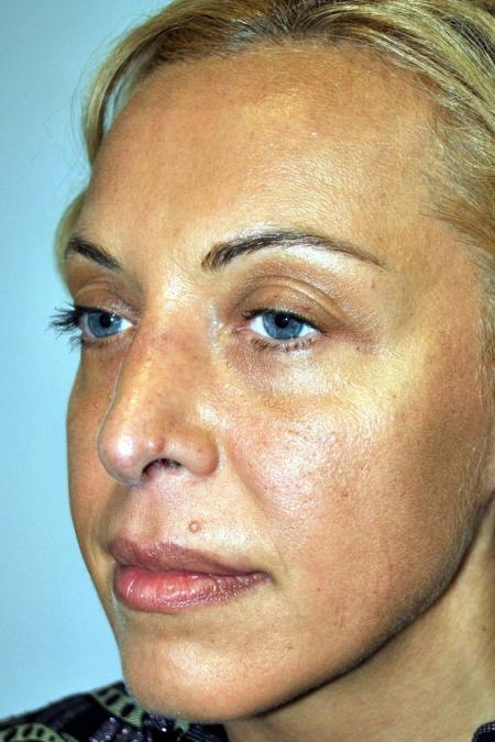 Before image 2 Case #122731 - Revision Rhinoplasty