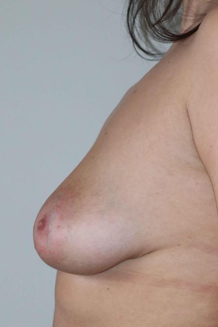 Before image 5 Case #122806 - MASTOPEXY AUGMENTATION