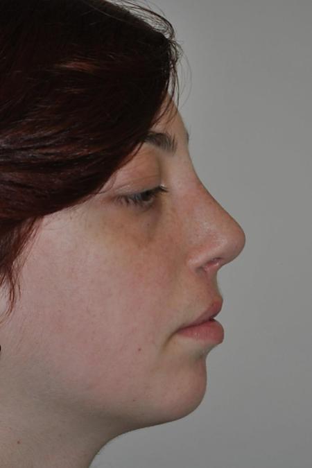 After image 3 Case #122581 - Cleft-Lip Nose Secondary Reconstruction