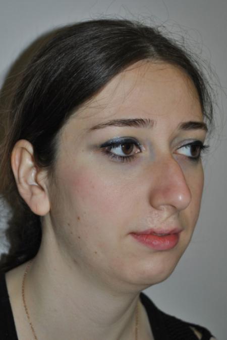 Before image 2 Case #122736 - Hybrid Rhinoplasty