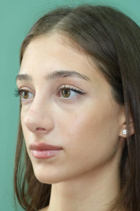 After image 2 Case #122801 - Reduction Rhinoseptoplasty