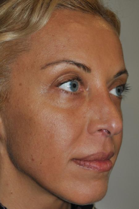 Before image 3 Case #122731 - Revision Rhinoplasty